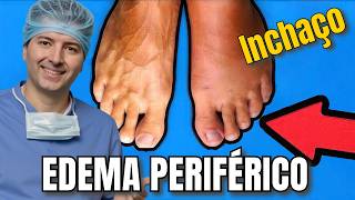 Inchaço nas pernas Edema periférico [upl. by Kelda]