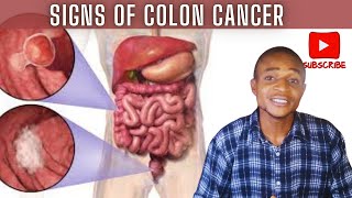 Signs and Symptoms of Colon Cancer Early Detection is Important [upl. by Sayers657]