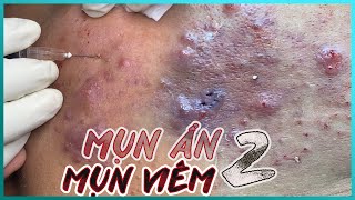 Big Cystic Acne Blackheads Extraction Blackheads amp Milia Whiteheads Removal Pimple Popping [upl. by Selby]