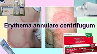 erythema annulare centrifugum [upl. by Ejrog502]