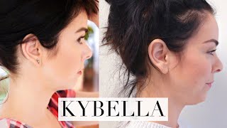 My Kybella Experience [upl. by Calesta]