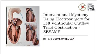 Interventional Myotomy Using Electrosurgery for Left Ventricular Outflow Tract Obstruction  SESAME [upl. by Venezia]