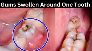 Why is my gums swollen around one tooth [upl. by Ssirk]