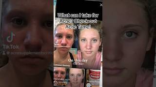 Get rid of acne skincare [upl. by Ashley]