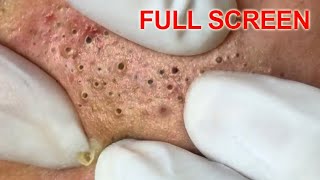 Blackheads removal  Best Pimple Popping Videos [upl. by Gwenette]