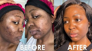 HOW I CLEARED MY ACNE  ACNE JOURNEY [upl. by Eelitan950]