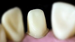 All ceramic crown preparation for anterior teeth Upper incisor مع الشرح خطوة بخطوة [upl. by Freyah]