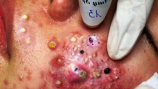 🤮puntos negro en la nariz extracción🔞🤢Black head [upl. by Aerdnaid595]