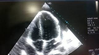 CARDIAC TAMPONADE ECHO APICAL FOUR CHAMBER VIEW [upl. by Aslehc]