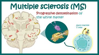 Multiple sclerosis  Types of Multiple Sclerosis  Causes symptoms diagnosis treatment pathology [upl. by Damalus]