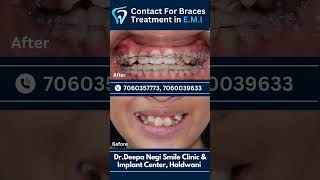 Braces Treatment Timepass  dentist toothdental facts dentalclinic doctor [upl. by Eitra]