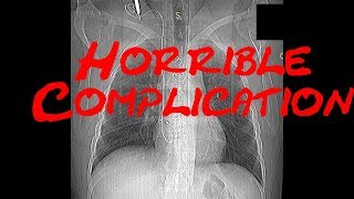 Horrible complication after cardiac intervention Cardiology Forum Echocardiography QuizCase [upl. by Prudence]