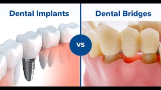 Which is better a dental bridge or implant [upl. by Eimoan761]