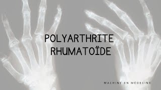 Polyarthrite Rhumatoïde PR [upl. by Eikcor]