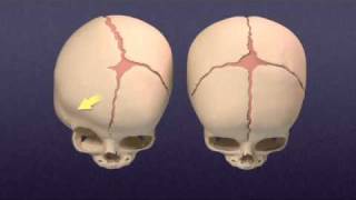 Craniosynostosis  Mayo Clinic [upl. by Adyela820]