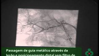 Angioplastia de Artéria Renal [upl. by Okun218]