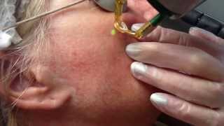 Laser treatment for facial thread veins with Candela NdYag laser [upl. by Munroe949]