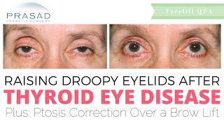 How Eyelid Ptosis Drooping Eyelid Can Happen After Thyroid Eye Disease Orbital Decompression [upl. by Cochard170]