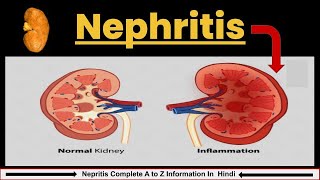 Nephritis in Hindi  Causes Symptoms amp Treatment  Nephrotic Syndrome  Nursing lecture [upl. by Tiphane]