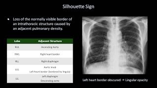 How to Interpret a Chest XRay Lesson 8  Focal Lung Processes [upl. by Androw]