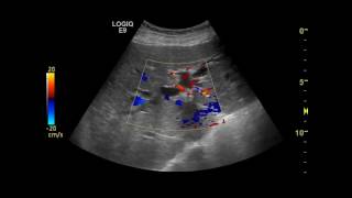 Mirizzi syndrome  Csendes classification type III by endoscopic retrograde cholangiography [upl. by Lanfri]