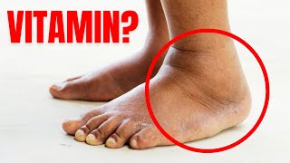 1 Vitamin to Eliminate Swelling in Feet and Legs [upl. by Mercy]