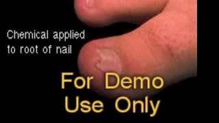 Partial Toenail Excision Phenol  Surgical Animation [upl. by Casilde]