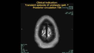 NPH  Normal Pressure Hydrocephalus  MRI Brain mri radiology [upl. by Osher]