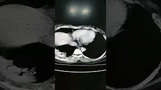 EMPHYSEMATOUS PYELONEPHRITISCT SCAN FINDINGSRadiology [upl. by Biagi]