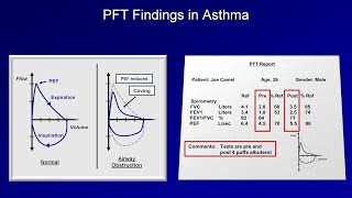 Asthma and COPD Stable Disease  Diagnosis and Management [upl. by Rosette]