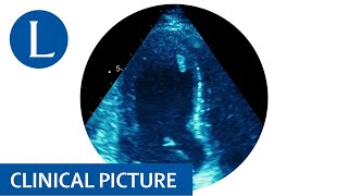 Takotsubo cardiomyopathy in a patient with Lynch syndrome [upl. by Oratnek]