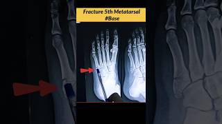 FRACTURE 5th Metatarsal Bone Xray Foot radiographerusn radiography xray bones [upl. by Rechaba378]