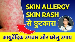 Skin Allergy amp Skin Rash Treatment in Ayurveda  चर्मरोग स्किन एलर्जी होने के कारण और घरेलु उपचार [upl. by Holub908]