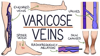 Understanding Varicose Veins [upl. by Niehaus808]