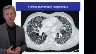 ECN PID cours 2 Fibrose pulmonaire idiopathique DFASM1 Pr V Cottin Lyon [upl. by Ahsinad]