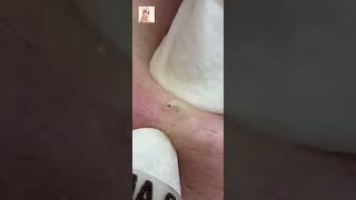 Blackheads Removal  Acne Treatment and Very Satisfying Satisfying Pimple pop blackheads [upl. by Corliss449]