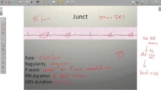 ECG Junctional Rhythms [upl. by Adnawed]