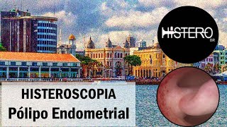 Histeroscopia Cirúrgica para Polipectomia  Pólipo Endometrial [upl. by Lessur107]