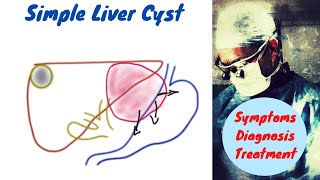 Simple Liver Cyst  Symptoms Diagnosis and Treatment [upl. by Westbrook962]