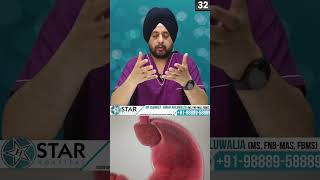 How Hiatus Hernia operation Is Done Hiatus Herania Fundoplication  Cure for Hiatus Hernia [upl. by Meeharb]