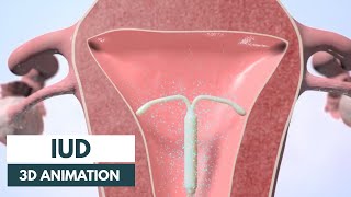 How does an IUD work  3D animation [upl. by Attem]