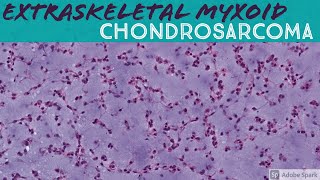 Extraskeletal Myxoid Chondrosarcoma 5Minute Pathology Pearls [upl. by Attela]