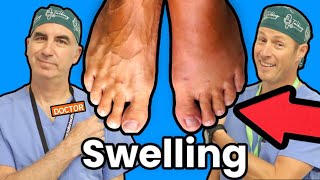 Foot and Ankle Swelling What Causes It [upl. by Rumit375]