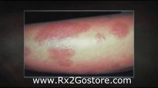 Mometasone Furoate Cream  How to Treat Psoriasis Effectively [upl. by Eltsyek300]