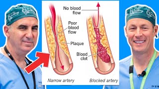 Peripheral Arterial Disease Symptoms Risks and Treatments [upl. by Walston]