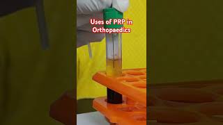 Uses of PRP in orthopaedics prp prptherapy prptreatment kneeosteoarthritis kneepainrelief [upl. by Nangem]