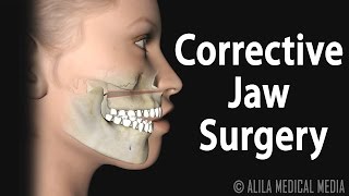 Corrective Jaw Orthognathic Surgery Animation [upl. by Airdnoed]