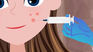 Cortisone Injection for a Big Pimple [upl. by Yraillih]