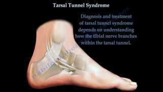 Tarsal Tunnel Syndrome  Everything You Need To Know  Dr Nabil Ebraheim [upl. by Pineda]