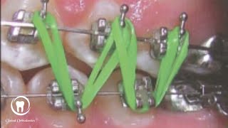 TTT of open bite video 8  use of intermaxillary elastics [upl. by Zelle432]